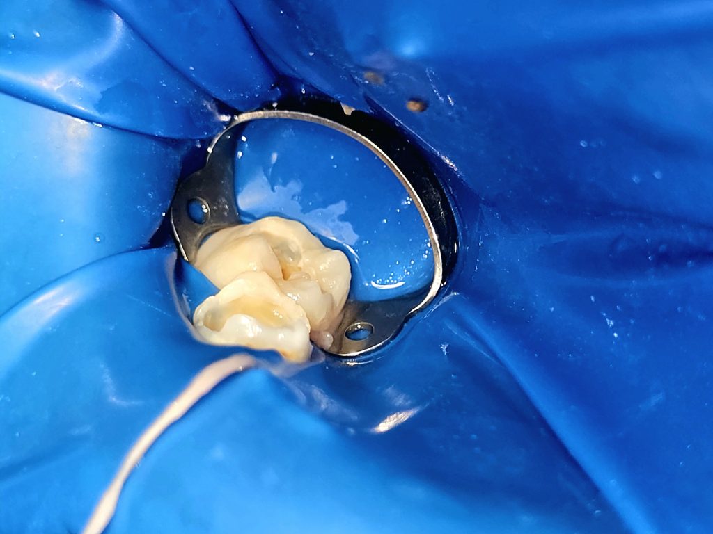 pulpotomía infantil