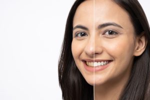 blanqueamiento don láser