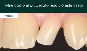 caso clínico restauración lateral