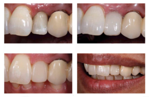 Carilla anterior directa mediante un composite para restauración en bloque universal con sistema de tonos simplificado.