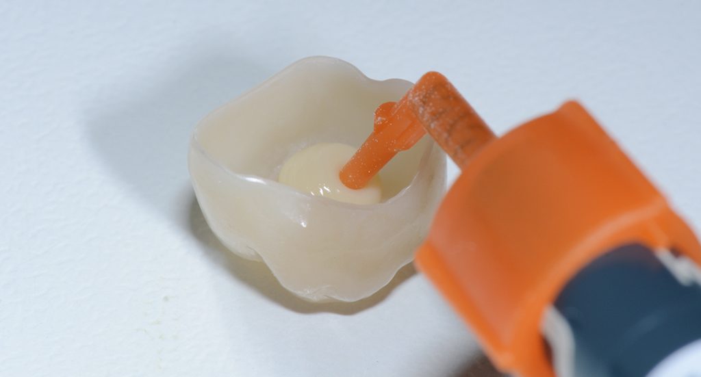 Explore el caso del Dr. Chiodera utilizando cemento de resina 3MTM RelyXTM Universal y adhesivo 3MTM ScotchbondTM Universal Plus para un procedimiento de trabajo simplificado.