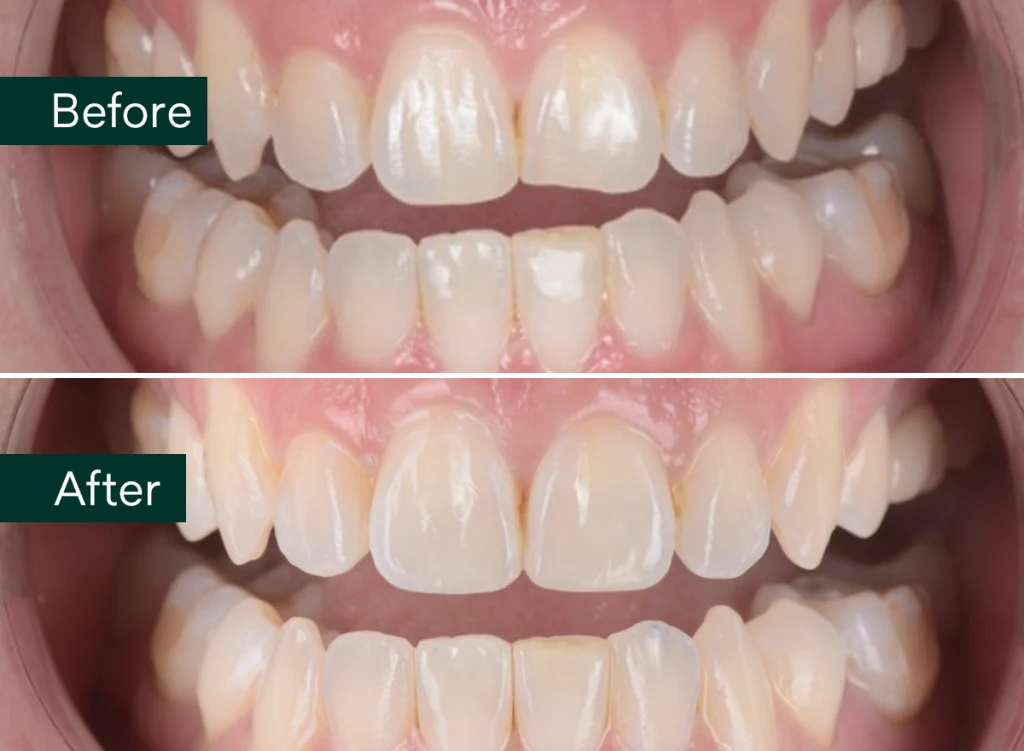 Caso clínico del Dr. Brian Baliwas sobre restauración estética post-ortodóntica con Filtek Easy Match Universal de Solventum, disponible en DVD Dental Solutions.