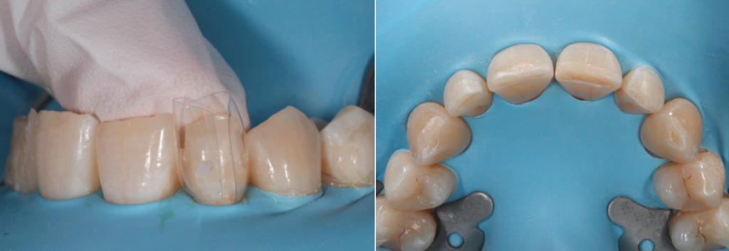 Descubre cómo el composite calentado facilita el manejo y la adaptación en una restauración estética anterior con Filtek Supreme XTE.