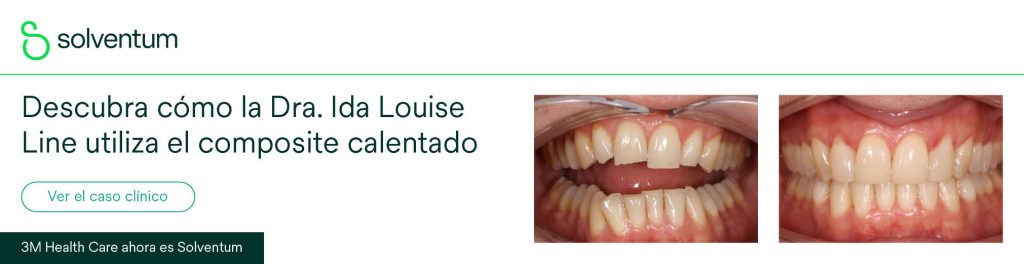 Descubre cómo el composite calentado facilita el manejo y la adaptación en una restauración estética anterior con Filtek Supreme XTE.
