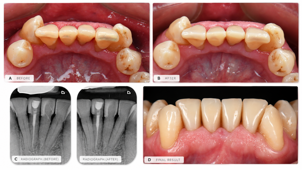 Técnica de composite inyectado con Filtek Easy Match Fluido para restaurar incisivos inferiores con carillas directas de aspecto natural.